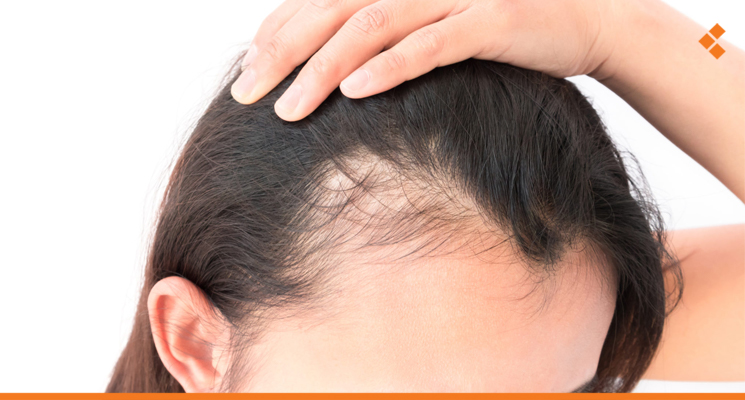 تعرف على "الصلع الإندروجيني".. 3مكملات طبيعية تمنع أسبابه