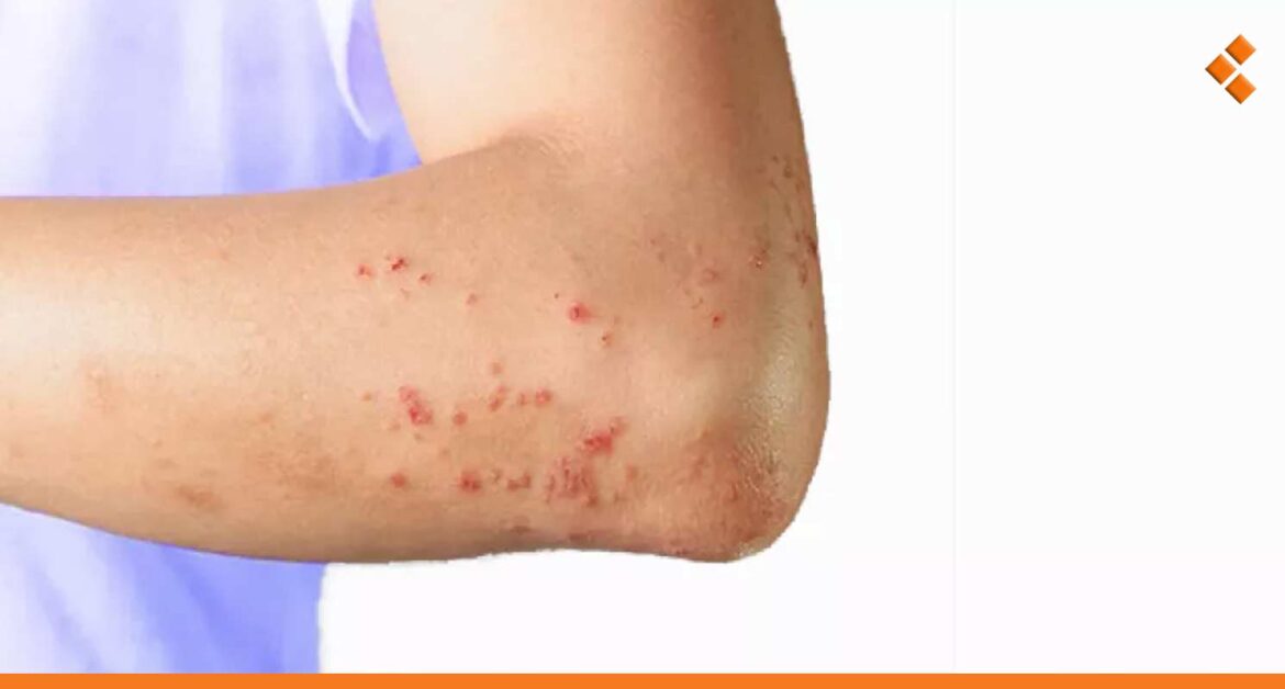 قـ.ـاتل وخطير.. ماهو مرض "الفرفرية" الذي تم تسجيل إصابات به في سوريا؟