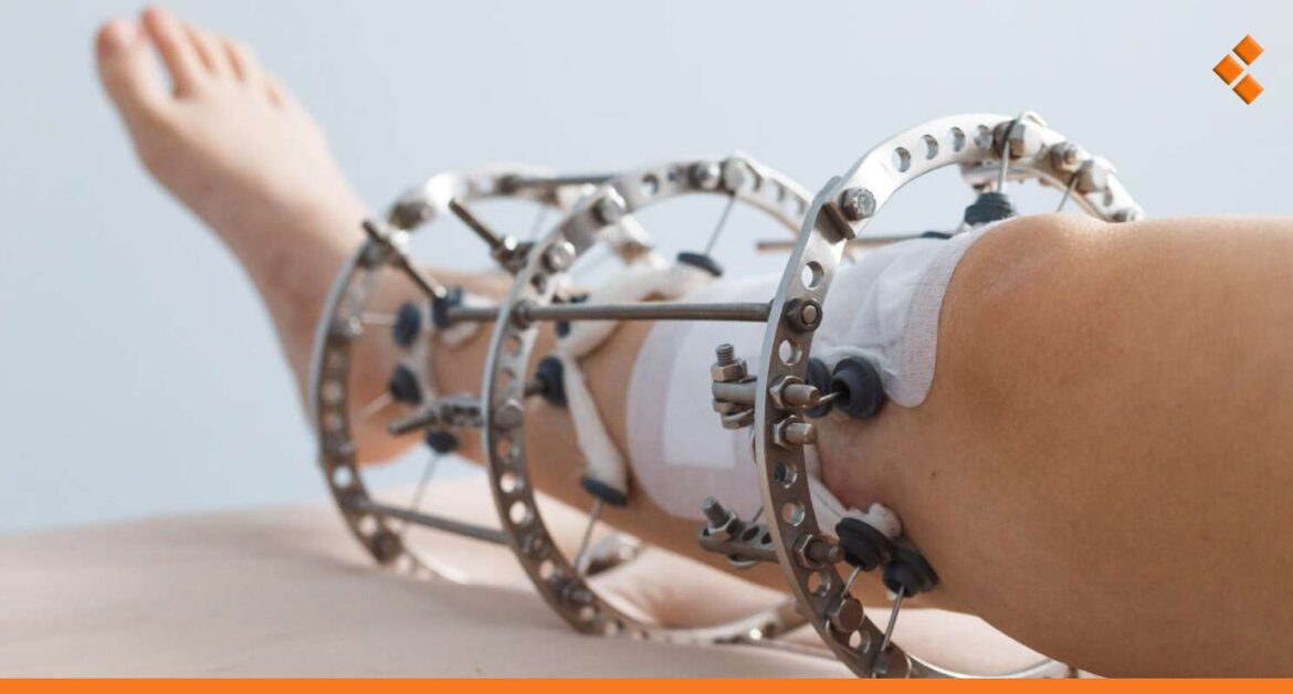 تكلفة "تطويل القامة" تتجاوز 200 مليون.. سوريون يروون تجاربهم مع عمليات زيادة الطول!