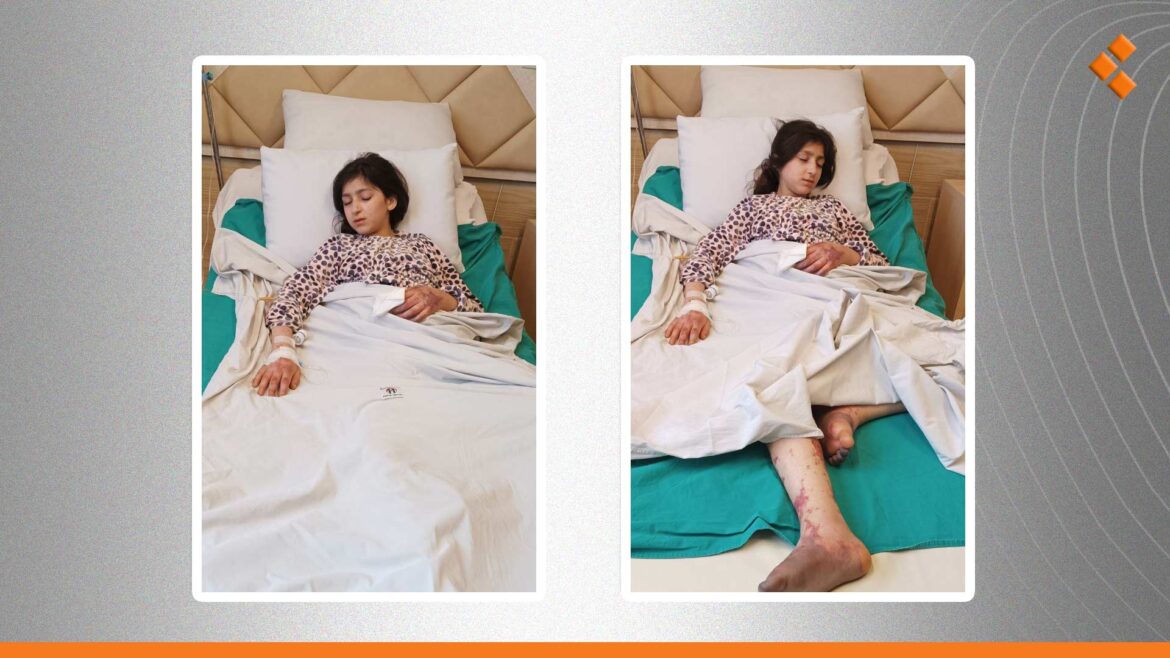 حلب.. بتر أصابع وجزء من مشط القدم اليمنى للطفلة تسنيم